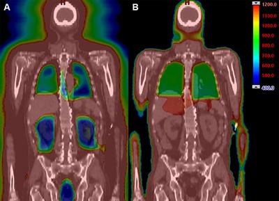 Long-term follow up of patients with hematological malignancies treated with total body irradiation using intensity modulated radiation therapy